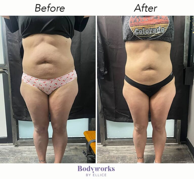 before-and-after-body-sculpting-bodyworks-by-ellice-4-min