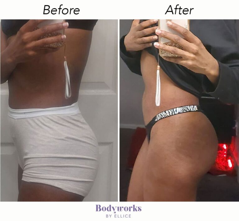 before-and-after-body-sculpting-bodyworks-by-ellice-5-min