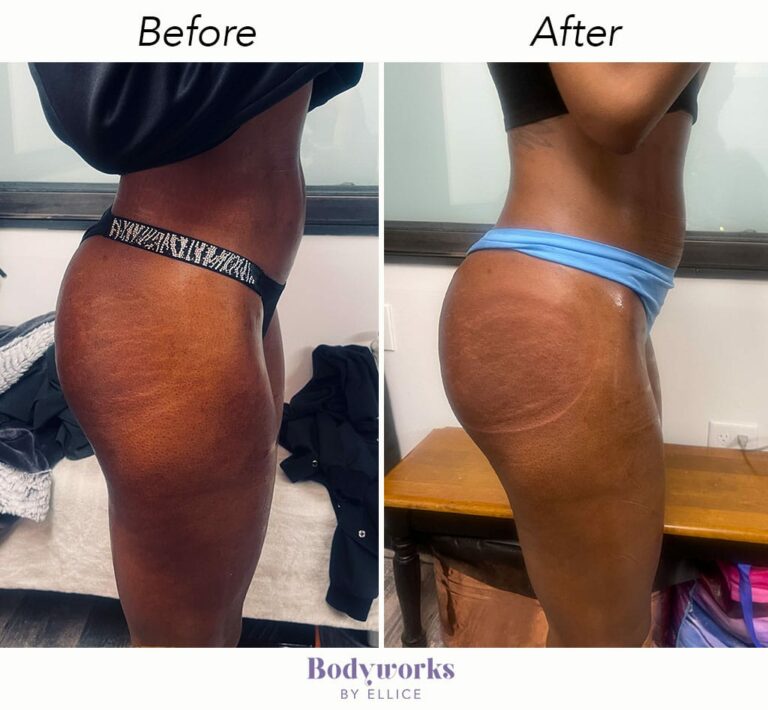 before-and-after-body-sculpting-bodyworks-by-ellice-6-min