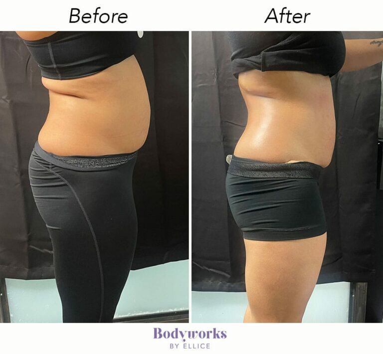 before-and-after-body-sculpting-bodyworks-by-ellice-7-min