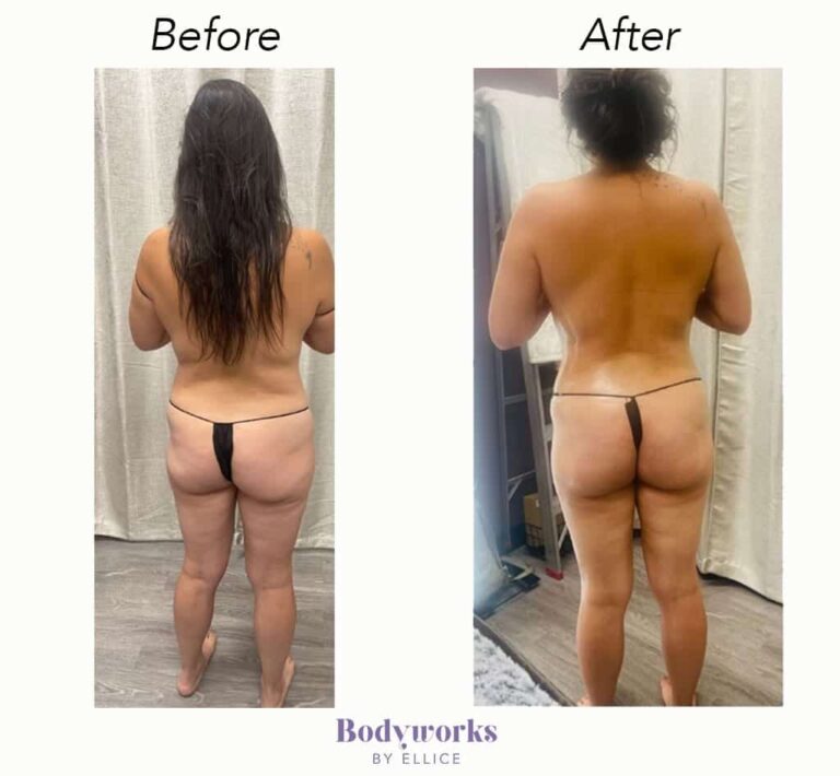 before-and-after-body-sculpting-bodyworks-by-ellice-3-min